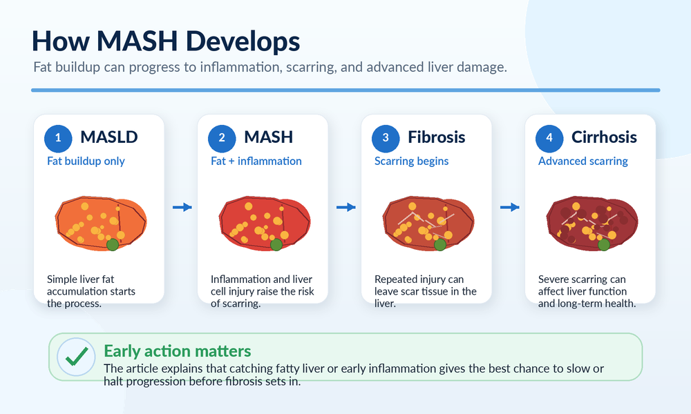 Progression of MASH liver disease from fat buildup to inflammation, fibrosis, and cirrhosis
