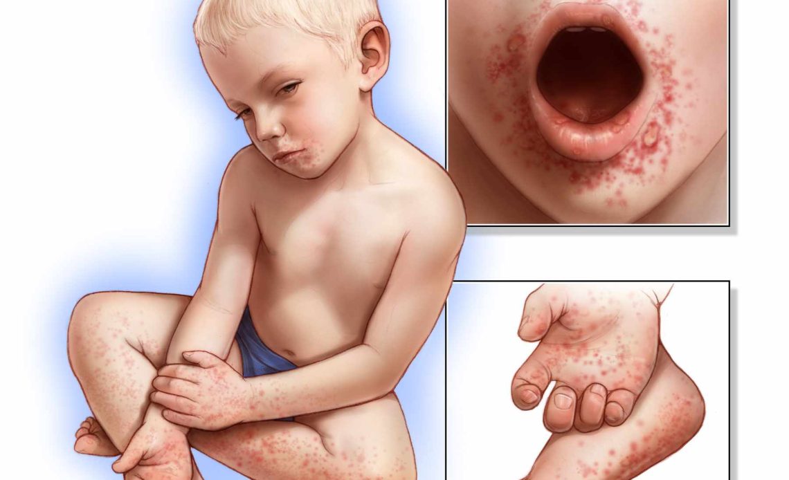 hand, foot, and mouth disease